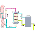 Hemodialysis