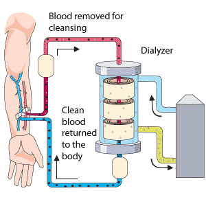 Hemodialysis