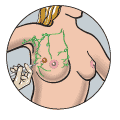 Breast Biopsy