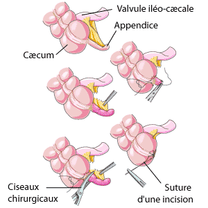 Les diverses étapes d'une appendicectomie, depuis l'ablation de l'appendice jusqu'à la suture de l'incision. Les diverses étapes d'une appendicectomie, depuis l'ablation de l'appendice jusqu'à la suture de l'incision.