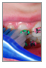 Brushing and flossing around braces