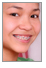 Why get braces?