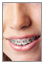 Types of braces