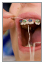 Flossing around braces