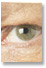A look at cataracts