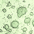 SP et la greffe de cellules souches