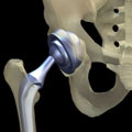 A fully-functional hip joint is created in a total hip replacement.