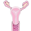 L'utérus est enlevé, les trompes de Fallope et le vagin restent intacts. Les hachures indiquent comment se fait l'ablation de l'utérus au cours d'une hystérectomie.
