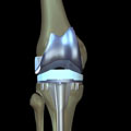 An artificial knee joint is created in a full knee replacement.