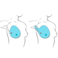 Examples of two types of mastectomies: a total mastectomy (left) and a modified radical mastectomy (right), courtesy of the Canadian Cancer Society.