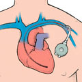 A pacemaker device implanted into the chest. Note the lead wire is inserted into the heart through a large vein.