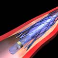 A blockage in the artery is widened by inflating the balloon catheter to fully expand the stent.