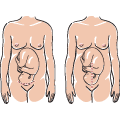 Either a horizontal (left) incision or a vertical (right) incision can be used in performing a caesarean section. The horizontal incision is more common.