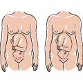 On peut effectuer une césarienne en pratiquant une incision dans le sens horizontal (illustration de gauche) ou dans le sens vertical (illustration de droite). L'incision dans le sens horizontal est la plus courante.