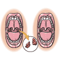 The mouth shown with the tonsils before a tonsillectomy (left) and after the tonsils have been removed (right). 