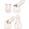 Les différentes étapes d'une vasectomie : des incisions sont effectuées dans le scrotum (en haut à gauche); les canaux déférents sont localisés et sectionnés (en haut à droite); les extrémités des canaux sont ensuite cautérisées pour les refermer (en bas à gauche); l'incision dans le scrotum est recousue (en bas à droite).