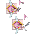 The surgical steps in tubal ligation; the fallopian tubes are tied off (top); the fallopian tubes are cut (bottom); the incision is sutured (not shown).
