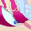 A tympanostomy tube, the small blue device near the bottom of the image, is inserted in the eardrum (tympanic membrane).