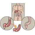 Après avoir enlevé une partie de l'intestin, on raccorde les 2 extrémités ensemble.