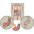 The bowel is reattached end to end following the removal of a portion of the bowel.