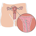 On utilise la curette pour éliminer du tissu de la muqueuse de l'utérus.