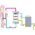 Schematic of the principles involved in hemodialysis. Blood flows from the body into the hemodialysis machine through a filter called a dialyzer. The dialyzer removes waste from the blood. This blood then re-enters the body.
