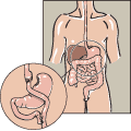 A large portion of the stomach is bypassed by a small stomach pouch connected directly to the small intestines.