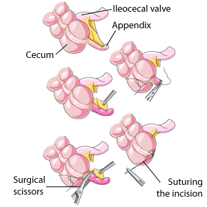 Les diverses étapes d'une appendicectomie, depuis l'ablation de l'appendice jusqu'à la suture de l'incision.