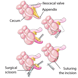 Les diverses étapes d'une appendicectomie, depuis l'ablation de l'appendice jusqu'à la suture de l'incision. Les diverses étapes d'une appendicectomie, depuis l'ablation de l'appendice jusqu'à la suture de l'incision.