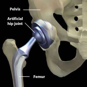 A fully-functional hip joint is created in a total hip replacement.