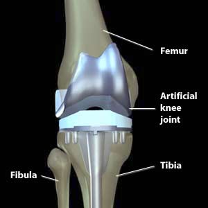 Lorsqu'il s'agit du remplacement total du genou, une prothèse de l'articulation du genou est mise en place.