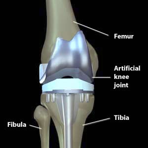 An artificial knee joint is created in a full knee replacement.