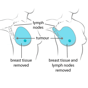Examples of two types of mastectomies: a total mastectomy (left) and a modified radical mastectomy (right), courtesy of the Canadian Cancer Society.
