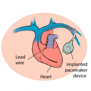 Un stimulateur cardiaque implanté dans le thorax. Le fil conducteur est introduit par voie veineuse jusqu'à la cavité cardiaque. Un stimulateur cardiaque implanté dans le thorax. Le fil conducteur est introduit par voie veineuse jusqu'à la cavité cardiaque.