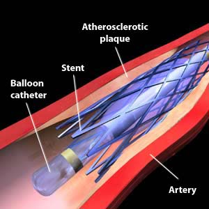 A blockage in the artery is widened by inflating the balloon catheter to fully expand the stent.