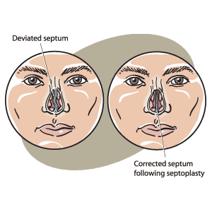 A deviated septum (left) can be corrected with a septoplasty procedure (right). 