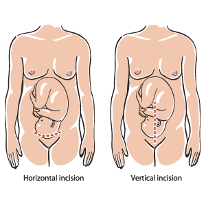 On peut effectuer une césarienne en pratiquant une incision dans le sens horizontal (illustration de gauche) ou dans le sens vertical (illustration de droite). L'incision dans le sens horizontal est la plus courante.