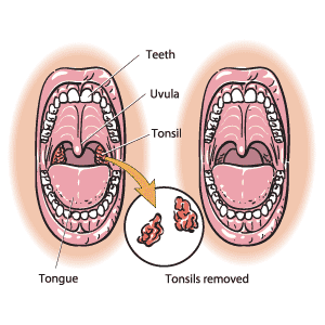 The mouth shown with the tonsils before a tonsillectomy (left) and after the tonsils have been removed (right). 