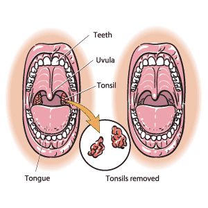 Repr&eacute;sentation de la bouche, avec les amygdales avant une amygdalectomie (&agrave; gauche), et apr&egrave;s l'ablation des amygdales (&agrave; droite).