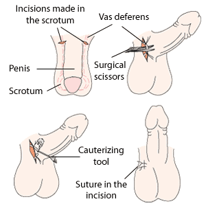 Les différentes étapes d'une vasectomie : des incisions sont effectuées dans le scrotum (en haut à gauche); les canaux déférents sont localisés et sectionnés (en haut à droite); les extrémités des canaux sont ensuite cautérisées pour les refermer (en bas à gauche); l'incision dans le scrotum est recousue (en bas à droite).