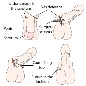 Les différentes étapes d'une vasectomie : des incisions sont effectuées dans le scrotum (en haut à gauche); les canaux déférents sont localisés et sectionnés (en haut à droite); les extrémités des canaux sont ensuite cautérisées pour les refermer (en bas à gauche); l'incision dans le scrotum est recousue (en bas à droite). Les différentes étapes d'une vasectomie : des incisions sont effectuées dans le scrotum (en haut à gauche); les canaux déférents sont localisés et sectionnés (en haut à droite); les extrémités des canaux sont ensuite cautérisées pour les refermer (en bas à gauche); l'incision dans le scrotum est recousue (en bas à droite).