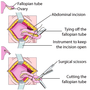Les &eacute;tapes d'une ligature des trompes; les trompes de Fallope sont r&eacute;unies avec un lien (haut); les trompes de Fallope sont sectionn&eacute;es (bas); les bords de l'incision sont sutur&eacute;s (pas illustr&eacute;).