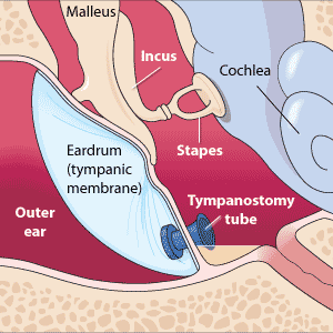 A tympanostomy tube, the small blue device near the bottom of the image, is inserted in the eardrum (tympanic membrane).