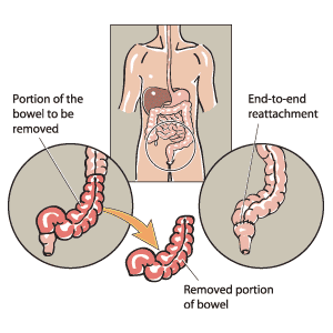 The bowel is reattached end to end following the removal of a portion of the bowel.