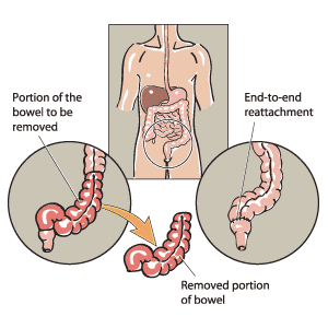 Résection de l'intestin - SanteChezNous.com