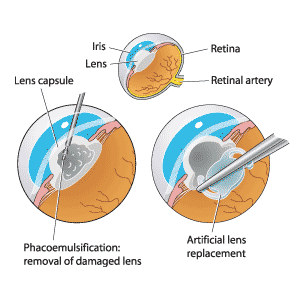 The cataract is removed from the eye lens with a phacoemulsification procedure (bottom left) and replaced with an artificial lens.