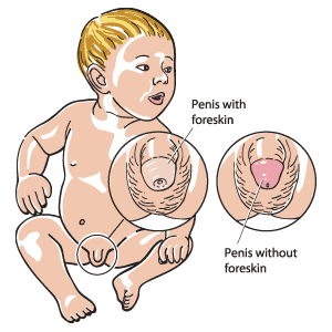 The penis shown before the circumcision with the foreskin (left inset) and after the circumcision without the foreskin (right inset).