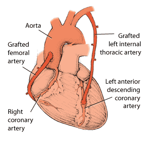Two coronary artery bypass grafts in different parts of the heart.