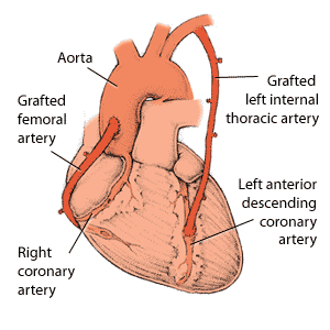 Pontage par greffe de deux artères coronaires de différentes parties du cœur.