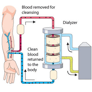 Représentation schématique de l'hémodialyse. Hors du corps, le sang circule dans le générateur d'hémodialyse en passant à travers un filtre appelé dialyseur et qui permet d'épurer le sang des déchets qu'il contient. Le sang revient ensuite vers le corps.